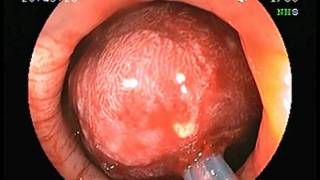 Polypectomy for large sigmoid colonic polyp [upl. by Court362]