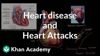 Heart disease and heart attacks  Miscellaneous  Heatlh amp Medicine  Khan Academy [upl. by Oigolue]