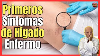 🔴 ¿CUALES SON LOS PRIMEROS SÍNTOMAS DEL HÍGADO ENFERMO E INFLAMADO 🔴 [upl. by Nellahs]