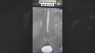 Uncover the Beginners Guide to MRI Spine Myelogram Sequences [upl. by Iffar]