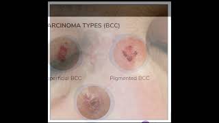 Basal Cell Carcinoma Symptoms and Causes  Diagnosis  Treatment  Prevention health [upl. by Latonia]