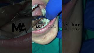 extraction of malposed lower second premolar using forceps [upl. by Lebbie967]