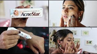 Acnestar Gel Review  HOW TO REALLY GET RID OF ACNE  SuperWowStyle Prachi [upl. by Mackay482]