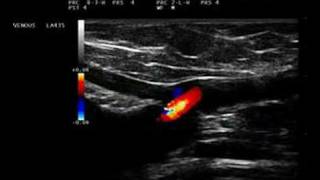 Phlebology Biosound Esaote MyLab 25 SFJ with reflux [upl. by Dnama615]