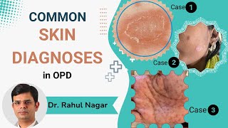 Common Skin Diagnoses In OPD [upl. by Thgirw]