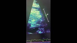 Anomalous tendon in the left ventricular outflow tract well identified [upl. by Monson]