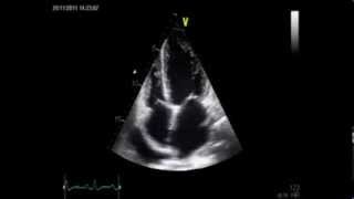 Dialysis echocardiogram 12 [upl. by Glaudia]