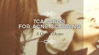 TCA CROSS for acne scarring [upl. by Euv]