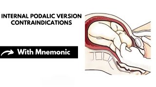 Internal Podalic Version Contraindications With Mnemonic  Obstetrics Mnemonics  Dr Mubashar Ata [upl. by Cecile]