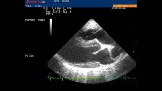 Echocardiography right parasternal longaxis view showing [upl. by Judd]