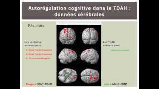 Corrélats cérébraux de lautorégulation cognitive dans le TDAH [upl. by Nata]