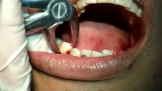 HUETEDENTAL Exodoncia de Premolares inferiores  34 y 44  Dr Rigoberto Huete [upl. by Ennazus]