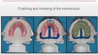 Clinical Case LOCATOR RTx by Nadim Baba DDS [upl. by Norword]