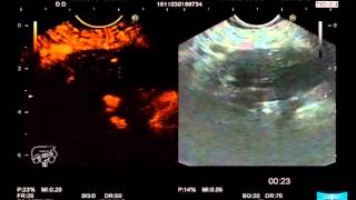 EUSGuided FineNeedle Aspiration for the Diagnosis amp Staging of Pancreatic Masses [upl. by Hachmann]