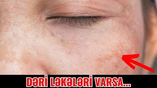 Dəri ləkələrinin Yaranma Səbəbi Nədir  HORMONALDIR [upl. by Higgs]