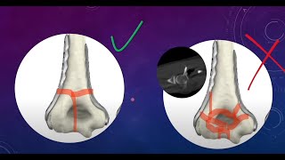 Complex Distal Intercondylar humerus Fractures Part I surgical planning [upl. by Edmead]