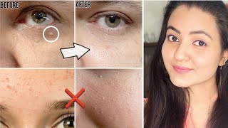 कितने भी मुश्किल MILIA मिलिया TINY BUMPS WHITE BUMPS हो इस Remedy से होगा 100 इलाज  100 Results [upl. by Aenneea]