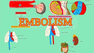 Pathology 18HDD 4  EMBOLISM  Pulmonary thromboembolism  Systemic thromboembolism AfSoomaali [upl. by Gervais]