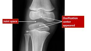 Age Estimation From Knee Xray [upl. by Aneger]