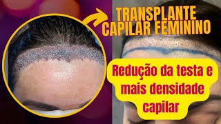 Fiz Transplante Capilar Feminino para redução de testa e densidade capilar Valores Como é feito [upl. by Illoh]