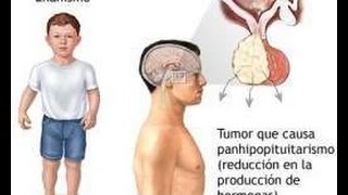 HIPOPITUITARISMO DISMINUCION DE HORMONAS PITUITARIAS [upl. by Rednasela44]