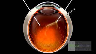 ¿EN QUÉ CONSISTE LA VITRECTOMÍA  CLÍNICAS NOVOVISIÓN [upl. by Nawotna]