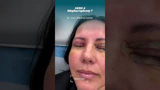 Blepharoplasty surgery eyelid  Doctor Levy Romania plastic surgeon [upl. by Zailer]