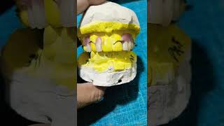 Acrylic Partial Denture Ready For Flasking 😁😁dentalartbyhaider rpd dentures [upl. by Vyky]