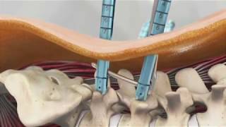 Palisade™ Pedicular Fixation System Animation [upl. by Burner]