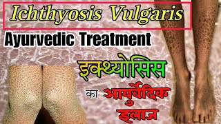 Ichthyosis Vulgaris Ayurvedic Treatment  Fish Scale Disease  Dr Mohammad Azam  इक्थ्योसिस [upl. by Micheline529]