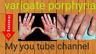 skin disease  varigate porphyria [upl. by Veradi]