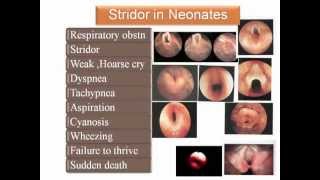 flexible laryngoscopy in congenital stridor [upl. by Kcirednek866]