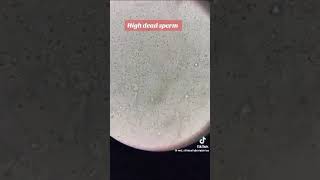 High motility 70 millions Dead sperm 30 Good HSA semen report [upl. by Enatan272]