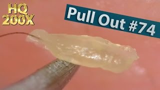 74 Pull Out Blackheads Close up 200X  Blackheads Removal [upl. by Dulci517]