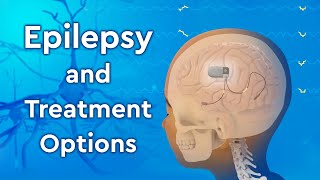 What is Epilepsy and How is it Treated [upl. by Barber123]