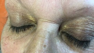 Xanthelasma dépots autour des yeux [upl. by Haet628]