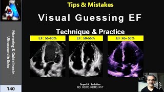 Visual Guessing Ejection Fraction Technique amp practice [upl. by Franciska555]