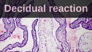 What is Decidual Reaction Pathology mini tutorial [upl. by Bartolome90]