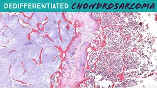 Dedifferentiated Chondrosarcoma with osteosarcoma heterologous area  hemipelvectomy UNC case 7 [upl. by Lida402]