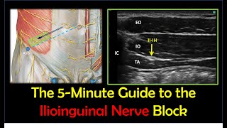 Ilioinguinal Nerve Block  A HowTo Guide [upl. by Peednam663]