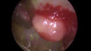 Ear Suction of Discharge Otorrhea in Infected Ear with Large Ear Pimple  332 [upl. by Doerrer]