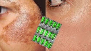 Pigmentation on face cream  Pigmentation on face treatment  How to remove pigmentation from face [upl. by Krahmer]