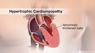 Hypertrophic cardiomyopathy HCM [upl. by Nenerb250]