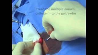 Femoral Vein  Central Venous Line Insertion [upl. by Elfie]