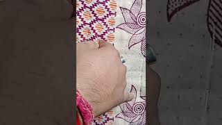 Radial nerve wrist drop recovery 15 month whatsapp [upl. by Ennagroeg]