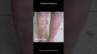 Erythema Nodosom [upl. by Laehplar476]