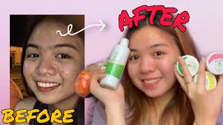 ZAINE SKIN SET REVIEW  PAANO NAWALA ANG PIMPLES at DARK SPOTS ko  Skin Story  Dianne [upl. by Eissert195]