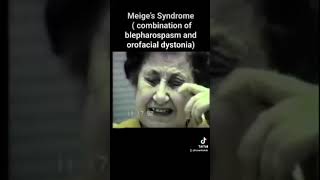 meige s syndrome combination of blepharospasm and orofacial dystonia [upl. by Goldberg]