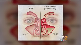 Doctor Tried And True Methods For Sinus Relief Are Still Best [upl. by Ritch]