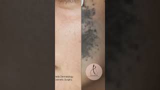 Successful treatment of Nevus of Ota Balat using Pico Laser [upl. by Isbella585]